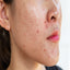 Best Ayurvedic Remedies for Acne-Free Skin Naturally