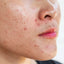 Best Ayurvedic Remedies for Acne-Free Skin Naturally